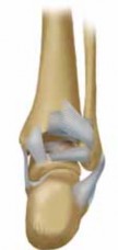 Illustration 4 for Optimal Fixation of the Ankle: Open Reduction & Internal Fixation