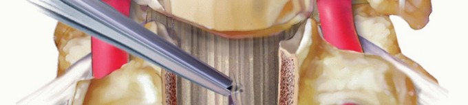 Illustration 13 for Stop Numbness & Instability: Corpectomy and Fusion Guide