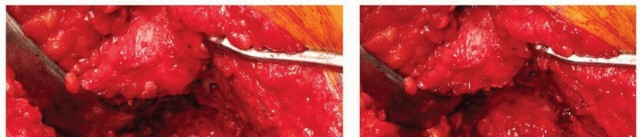 Illustration 24 for Uncemented Acetabular Revision: Optimizing Hemispherical Cup Use