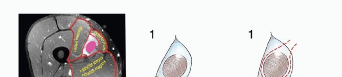 Illustration 3 for Optimizing Resection: An Overview of Surgical Approaches for Space Sarcomas
