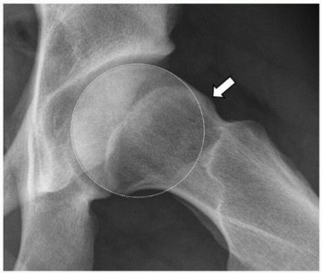 Illustration 5 for Beyond Knee Surg: Hip Arthroscopy for Sports Injuries