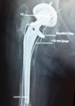 Illustration 11 for Templating for Revision: Navigate Complex Hip Arthroplasty