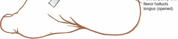 Illustration 56 for Optimized Approaches to the Dorsum of the Foot & Ankle