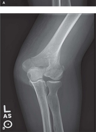 Illustration 2 for Mastering Distal Humerus Fractures: Diagnosis & Treatment