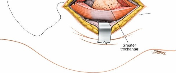 Illustration 137 for Unlocking Every Aspect of the Hip's Surgical Approaches