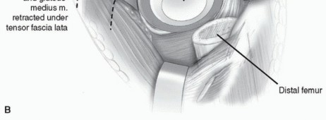 Illustration 13 for Recreate Hip Biomechanics: Modular Stems for Modular Solutions