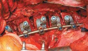 Illustration 46 for Mastering Anterior Interbody Arthrodesis with Instrumentation for Scoliosis