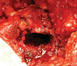 Illustration 34 for Femoral Stem Revision: Posterior Approach for Better Outcomes