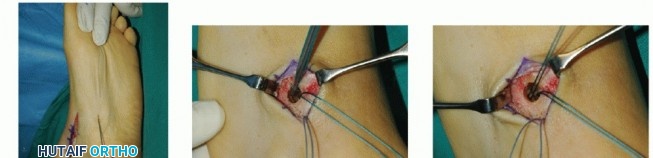 Illustration 19 for Restore Movement: Tendon Transfer for Common Peroneal Nerve Foot Drop