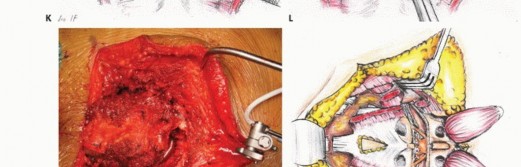 Illustration 38 for Sacral Tumor Surgery: Safeguarding Bowel & Bladder Control