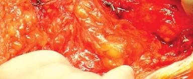 Illustration 36 for Posterolateral Surgical Approaches: Achieve Optimal Hip Replacement