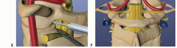 Illustration 13 for Addressing Cervical Spine Instability with Posterior Arthrodesis