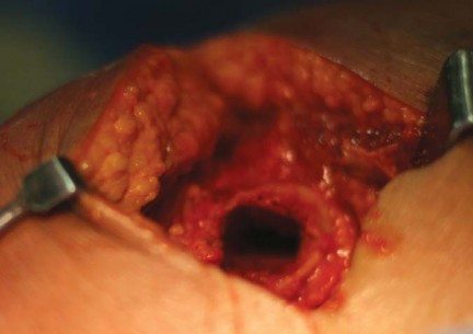 Illustration 30 for Considering METHA Short Stem? Discover Bone-Preserving THA