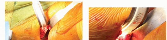 Illustration 44 for Anterior FAI Relief: Mini-Open Anterior Approach Explained