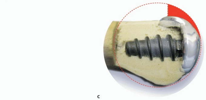 Illustration 13 for End Articular Cartilage Loss: Arthrosurface HemiCAP Resurfacing