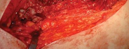 Illustration 80 for Femoral Stem Revision: Posterior Approach for Better Outcomes