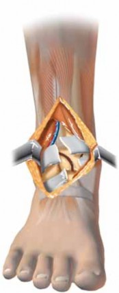 Illustration 35 for Optimizing ORIF for Tibial Plafond Fractures: A Modern Approach