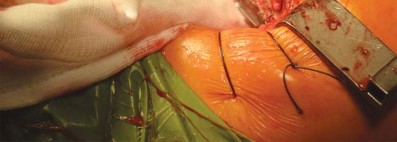 Illustration 53 for Kinectiv® Stem: Modular Necks for Primary THA Success