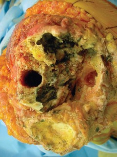 Illustration 22 for Precision Soft Tissue Balancing in Revision: Avoid TKA Pitfalls