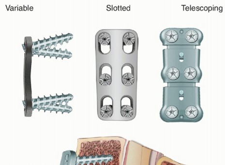 Illustration 25 for How ACDF Clears Your Posterior Disc Space for Lasting Relief