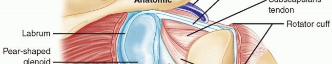 Illustration 2 for Glenoid Bone Graft for Anterior Shoulder Instability: Restore Stability