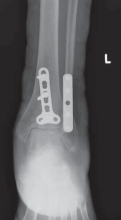 Illustration 33 for Optimal Fixation of the Ankle: Open Reduction & Internal Fixation