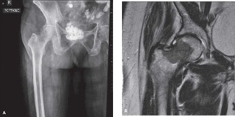 Optimizing the Management of Difficult Metastatic Lesions
