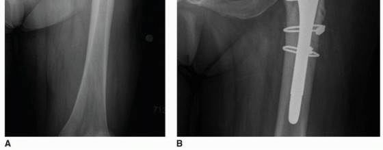 Illustration 5 for Overcoming Proximal Femoral Deformity in THA: Key Strategies