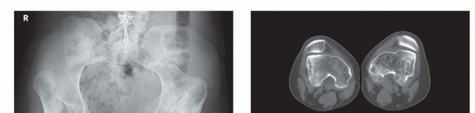 Illustration 4 for Special THA Techniques for Severe Deformities Around the Hip