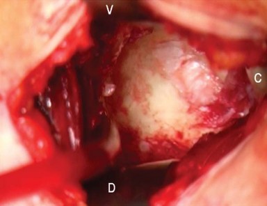 Illustration 10 for Mastering the Anterolateral Approach in Minimally Invasive Hip Replacement