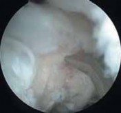 Illustration 39 for Precision Arthroscopy for Chondral Injuries & OCD: Direct Lateral Portal