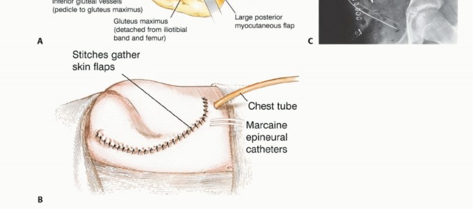 Illustration 27 for Posterior Flap Hemipelvectomy: Mastering Techniques for Optimal Outcomes