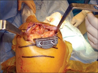 Illustration 7 for Minimal Incision Total Knee: Experience Faster Healing