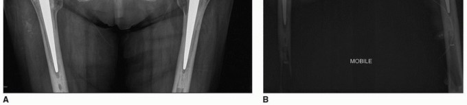 Illustration 53 for Cement in Cement Revision: Simplifying Complex Hip Revisions