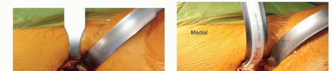 Illustration 14 for Anterior FAI Relief: Mini-Open Anterior Approach Explained