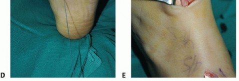 Illustration 57 for Restore Movement: Tendon Transfer for Common Peroneal Nerve Foot Drop