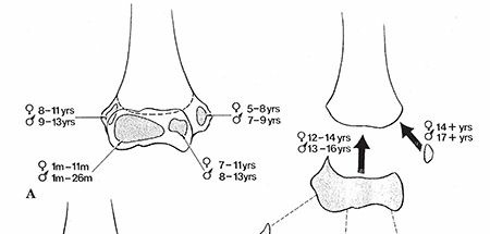 Pediatric Elbow Fractures & Dislocations: What You Need to Know