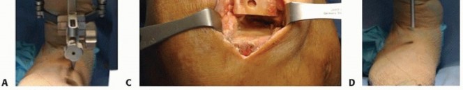 صورة طبية: استبدال مفصل الركبة الجزئي: حل متقدم لآلام الركبة المستمرة مع الأستاذ الدكتور محمد هطيف