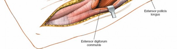 Illustration 10 for Posterior Radius: Expert Tips for Brevis and the Extensor Side