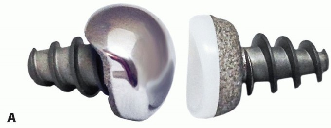 Illustration 56 for End Articular Cartilage Loss: Arthrosurface HemiCAP Resurfacing