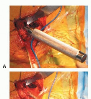 Illustration 32 for Hemiarthroplasty of the Hip: Indications & Types Explained