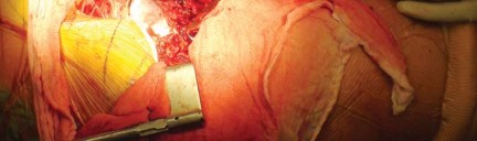 Illustration 15 for Effective Arthroplasty for Salvage of Failed Hip Fixation