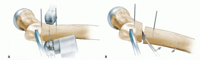 Illustration 13 for Proximal Femoral Osteotomy: When This Hip-Saving Surgery Is Performed
