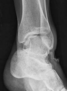 Illustration 3 for Tibial Fracture Extending into the Plafond: Intramedullary Secrets