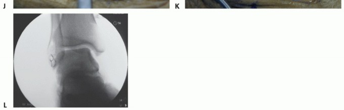 Illustration 25 for Lateral Ankle Repair: Maximize Stability with Interference Screw Fixation