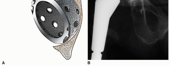 Illustration 5 for Uncemented Acetabular Component: Augments & Cup-Cages for Bone Loss
