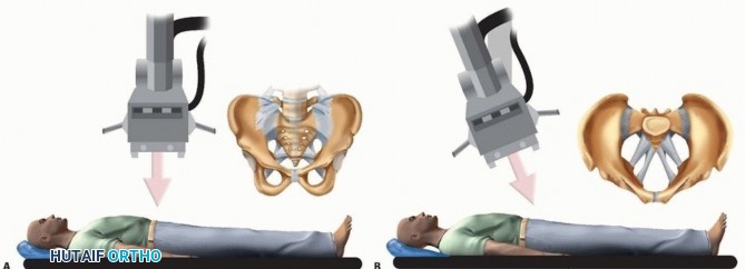 Illustration 3 for Emergency Fixation of the Pelvis: Control Bleeding & Restore Stability