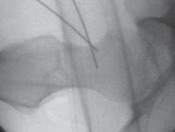 Illustration 33 for Resolving Femoral Head Neck Impingement: Arthroscopic FAI Solutions