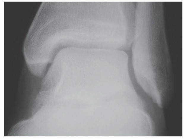 Arthroscopic Ankle Arthrodesis: Master the Procedure