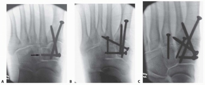 Illustration 21 for Fixation of Lisfranc Injuries: Essential Open Reduction Guide